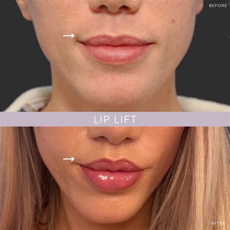 lateral philtrum reduction lip lift.